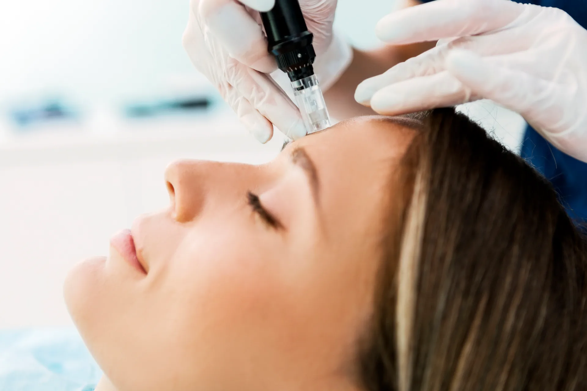 Microneedling at Everis Aesthetic Medicine in Milpitas, CA