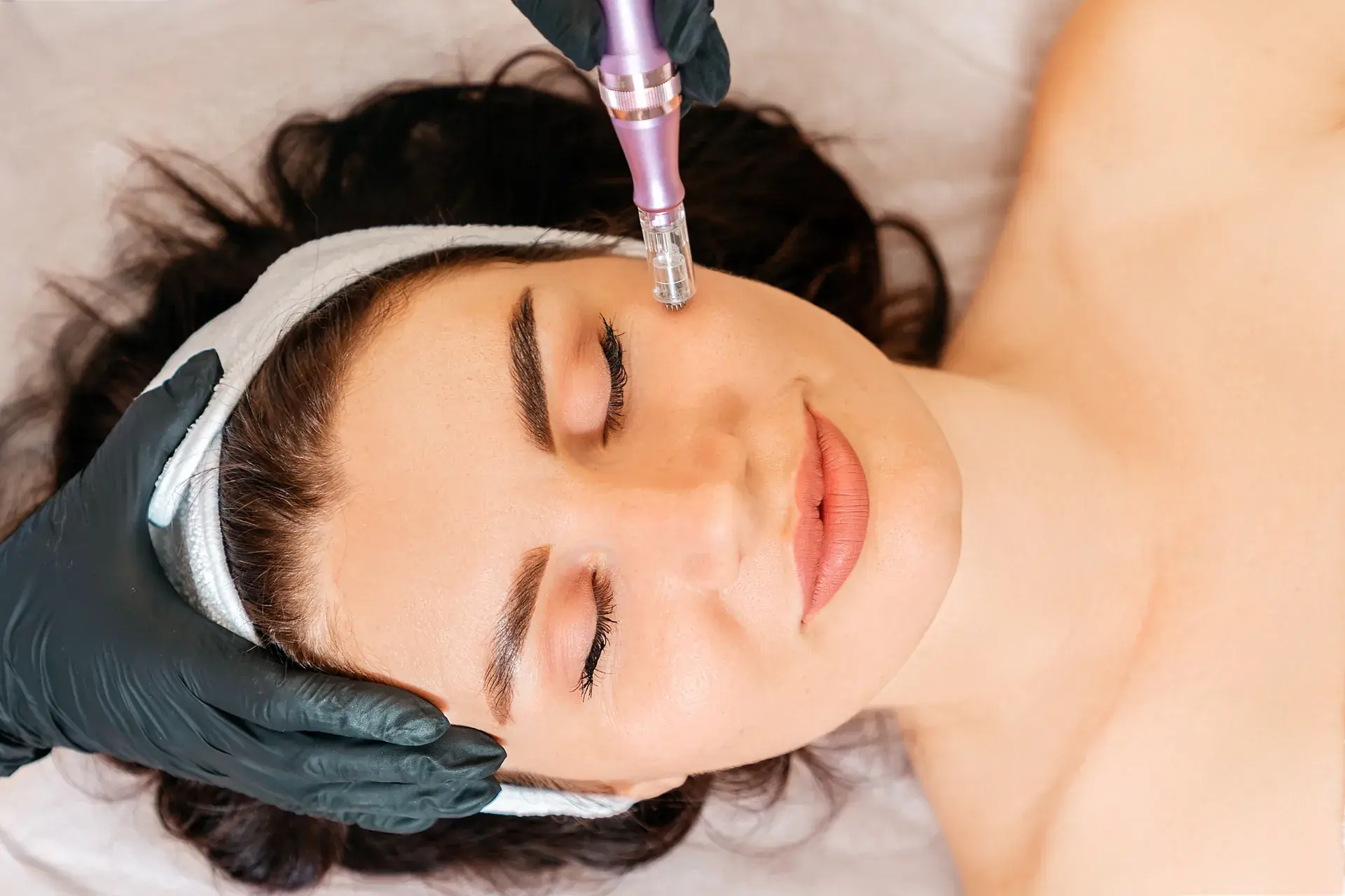 Microneedling treatment at Everis Aesthetic Medicine in Milpitas, CA